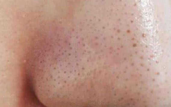 清潔面膜哪個(gè)牌子可以快速祛黑頭？趙薇、薇婭 推薦的紐西之謎泥膜真的好用嗎？